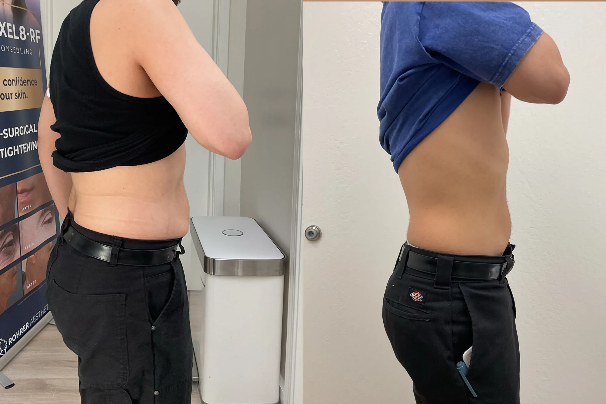 Before and after Evolve body contouring, side view of the abdomen, flatter after treatment