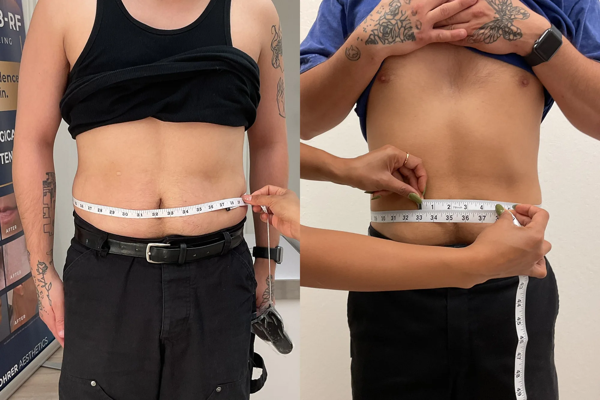 Before and after Evolve body contouring, front view of a man's waist with a tape measure