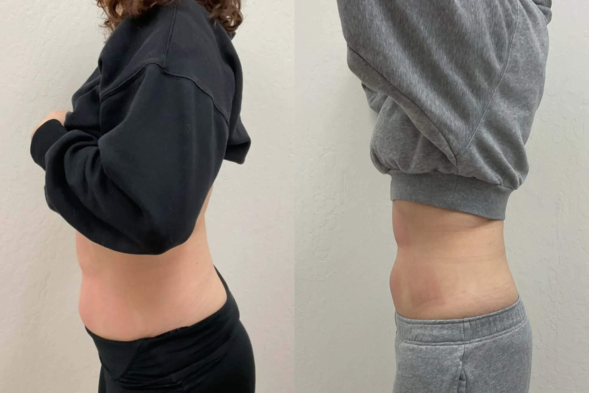 Before and after Evolve body contouring, side view of a woman's abdomen, flatter after treatment