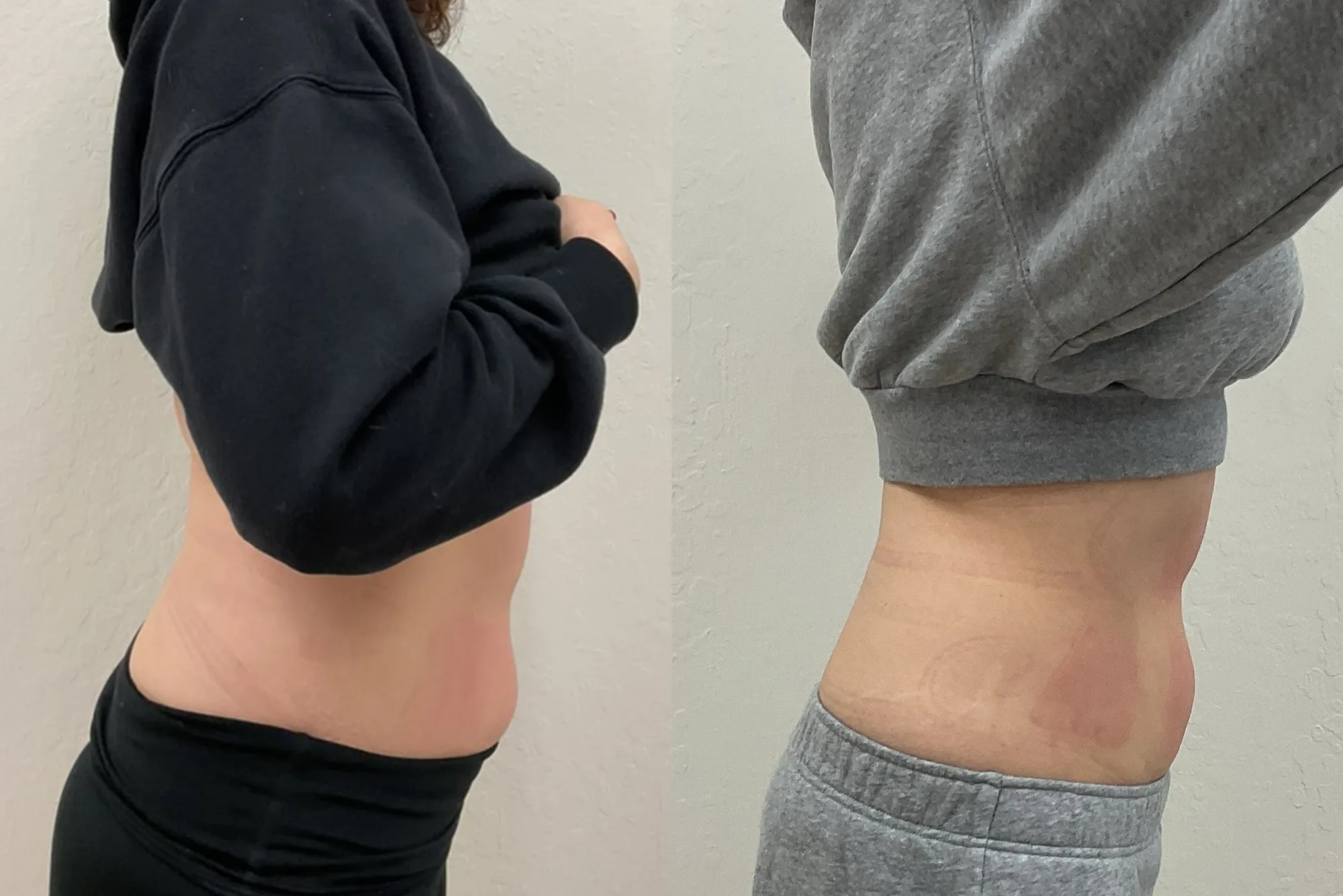 Before and after body contouring, close side view of the abdomen, with a trimmer profile after