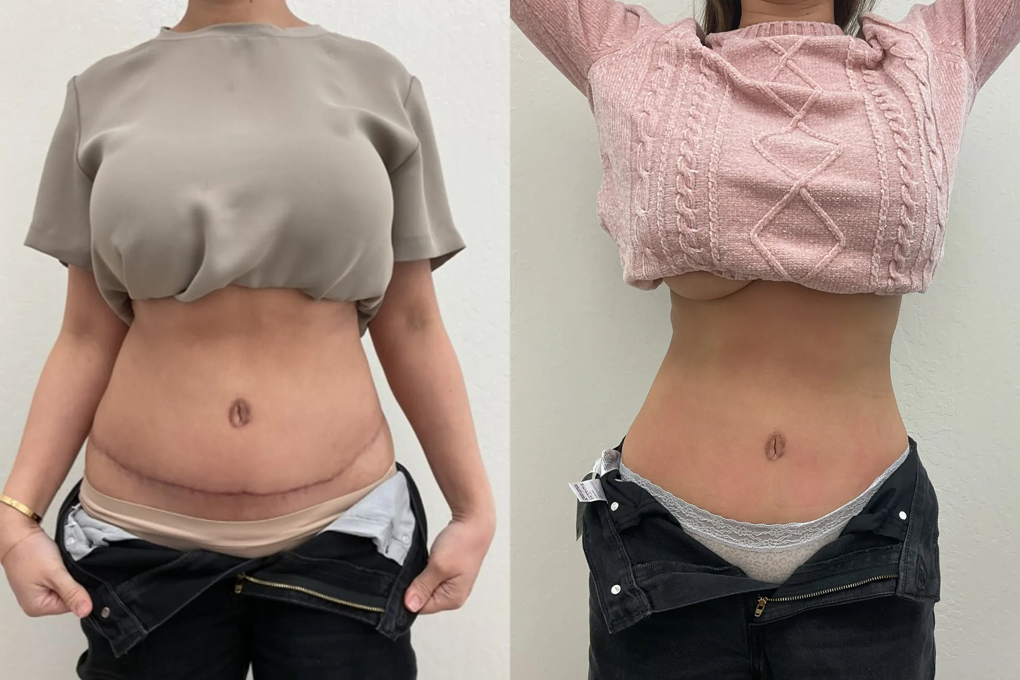 Before and after Evolve body contouring, front view of a woman's abdomen, firmer and flatter after