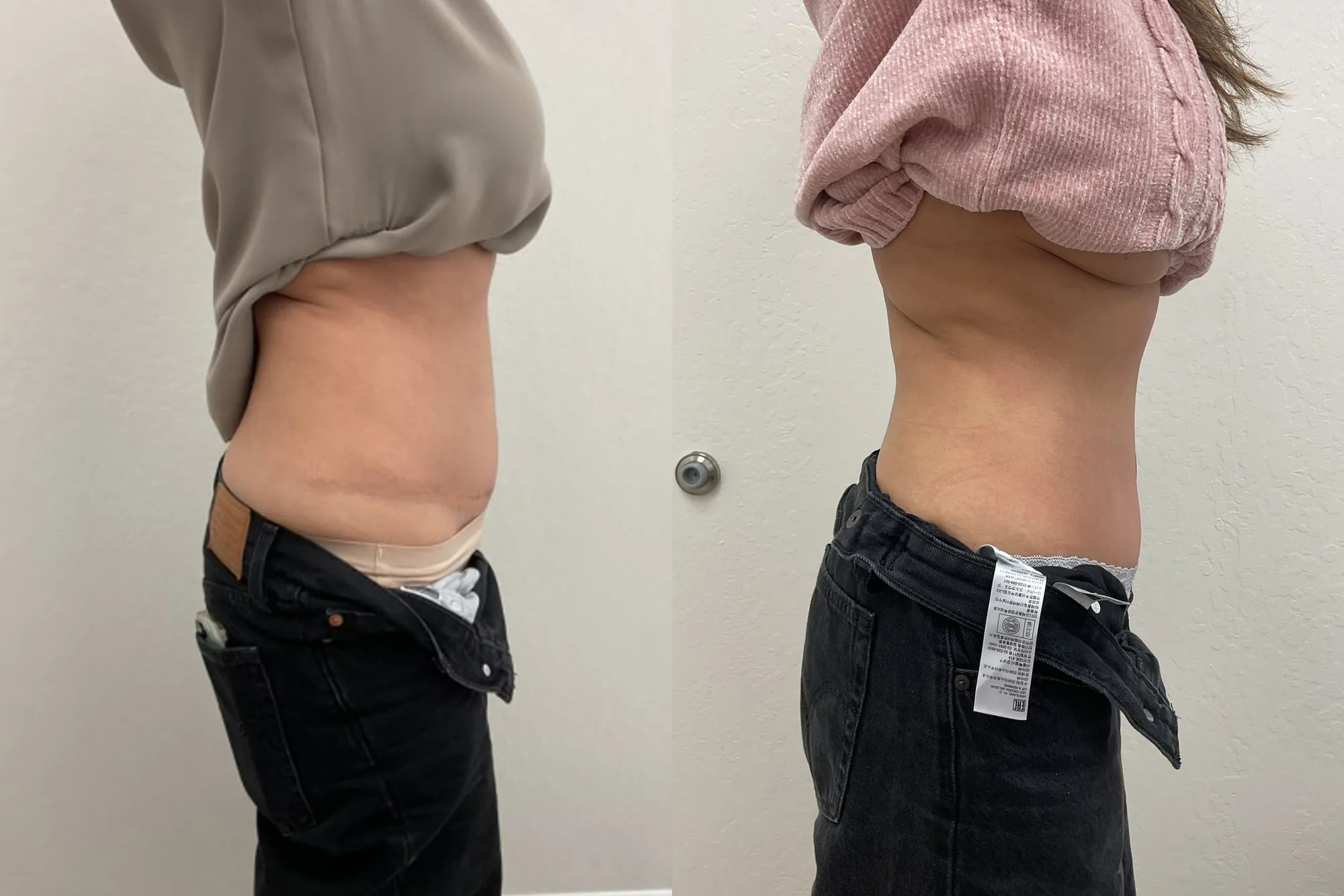 Before and after Evolve body contouring, side view of a woman's waist and abdomen, flatter after