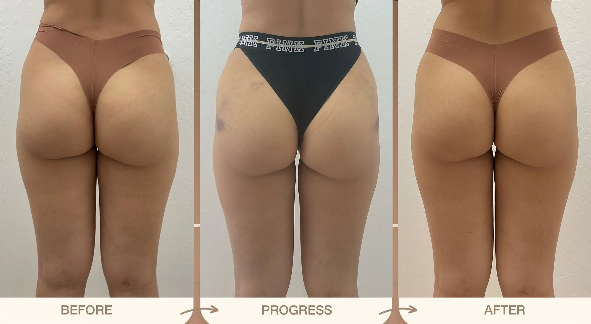 Radiesse butt lift from behind in three stages, before, progress and after, with a lifted, smoother shape