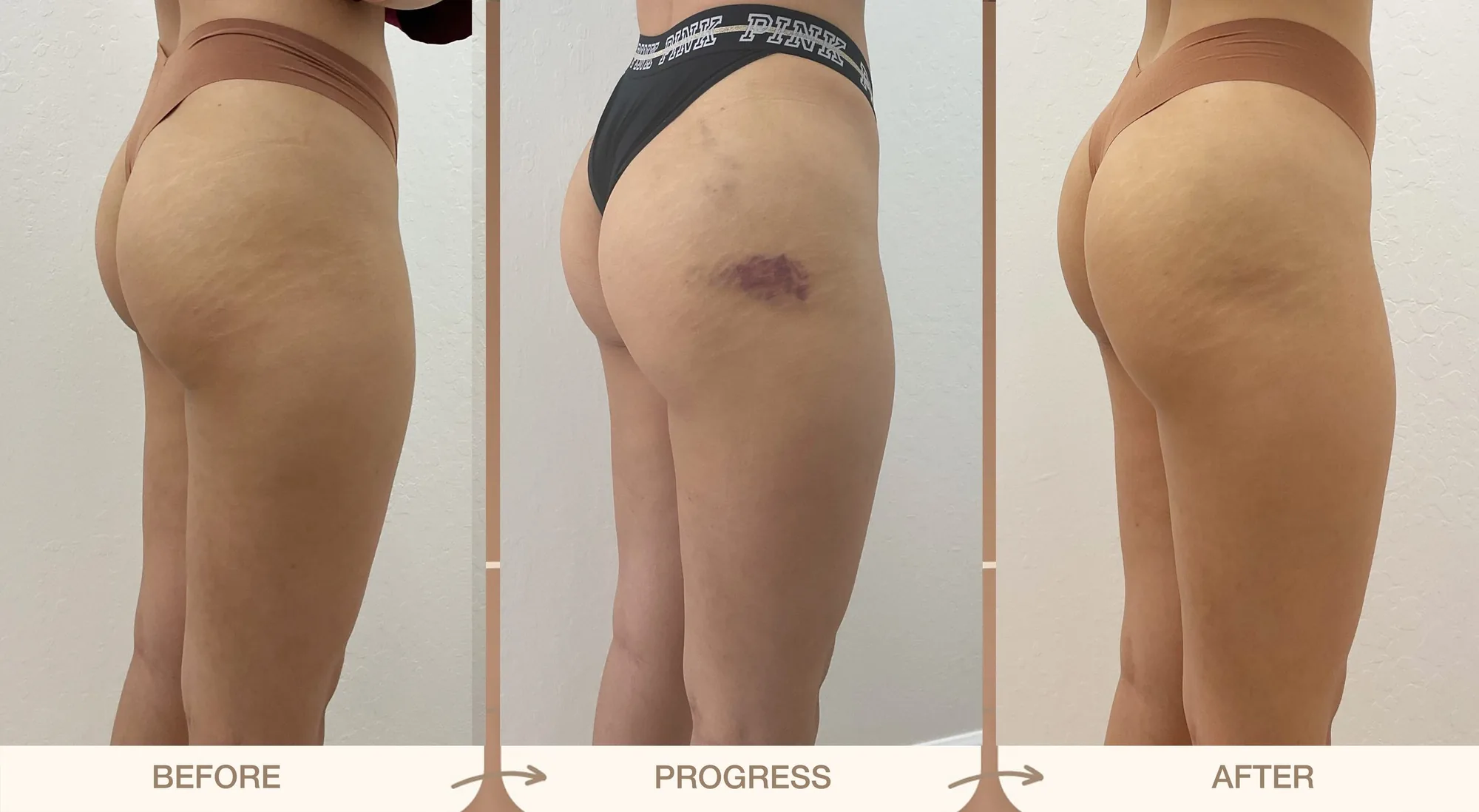 Radiesse butt lift from the side in three stages, before, progress with bruising, and after, with more lift