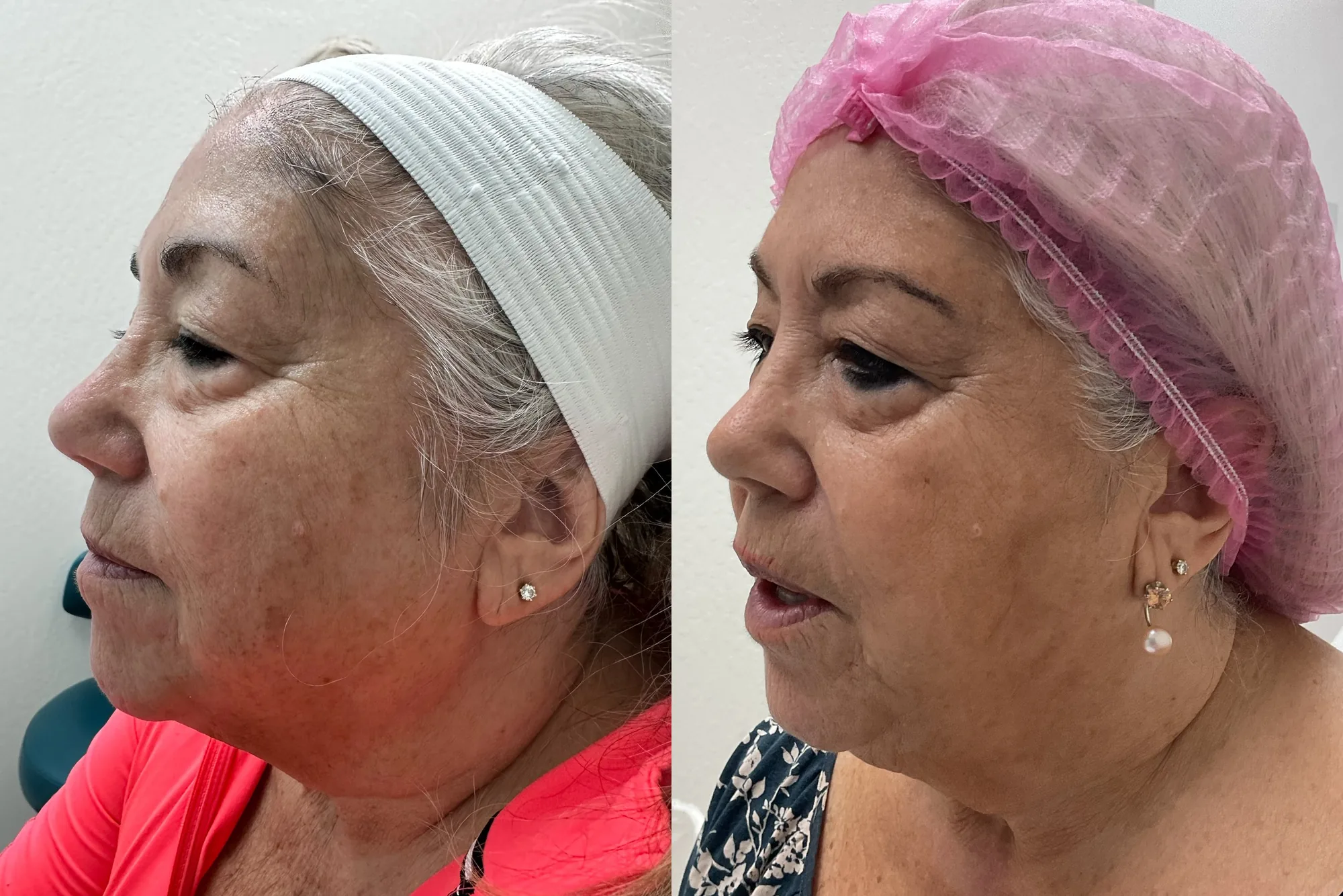 Before and after a combined treatment plan, a woman in profile, with smoother, brighter skin after