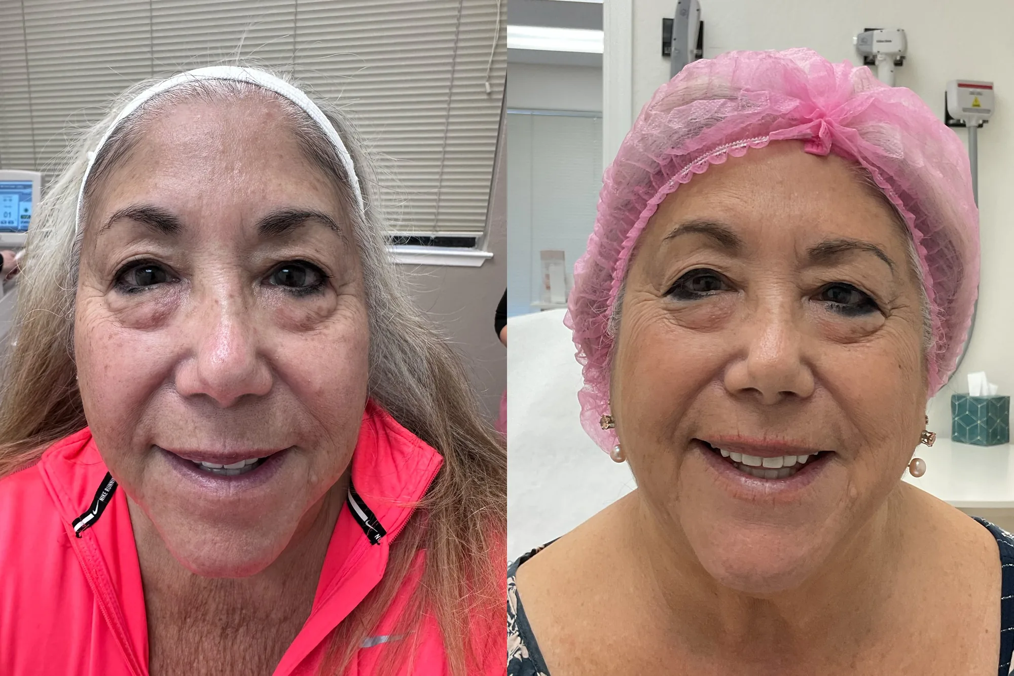 Before and after a combined treatment plan, the same woman front-on, with fresher, more even skin after
