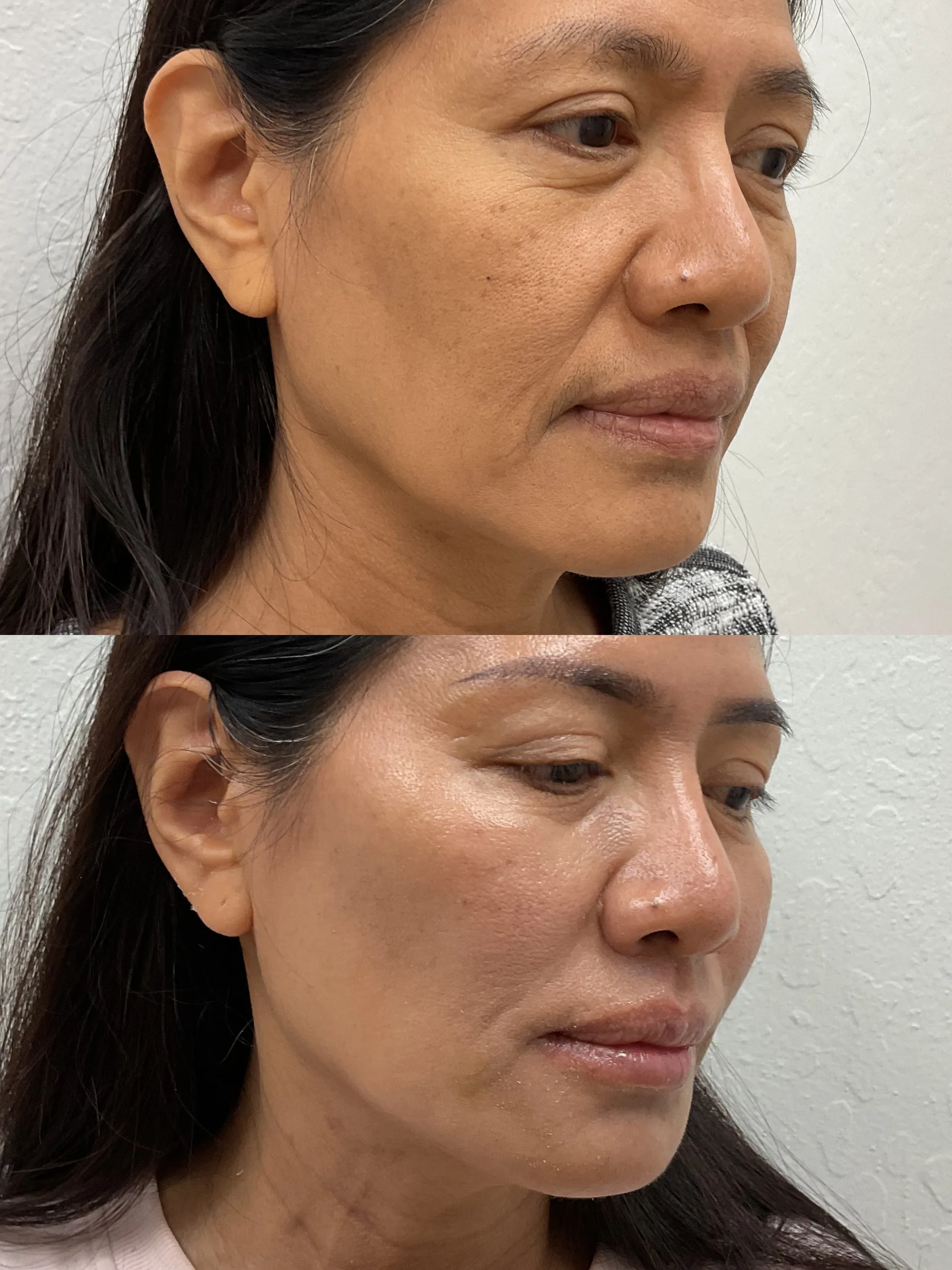 Before and after a combined treatment plan, a woman at an angle, with smoother, more lifted skin after
