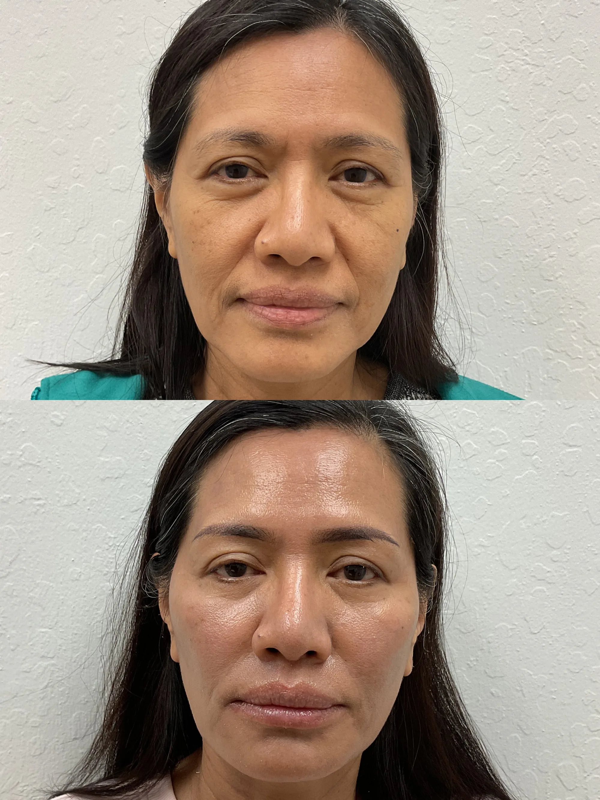 Before and after a combined treatment plan, the same woman front-on, with brighter, more even skin after