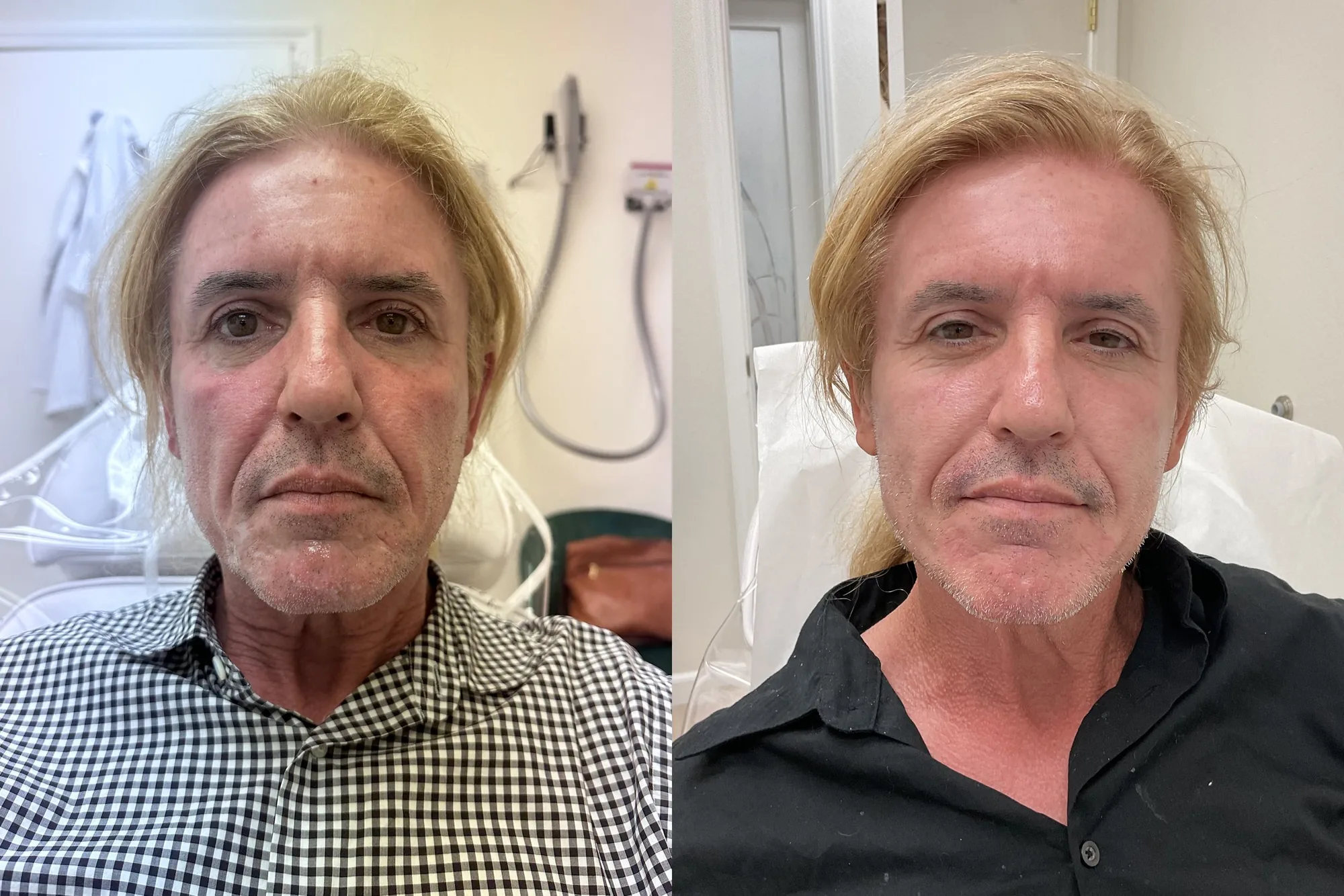 Before and after a combined treatment plan, a man front-on, with smoother, clearer skin after