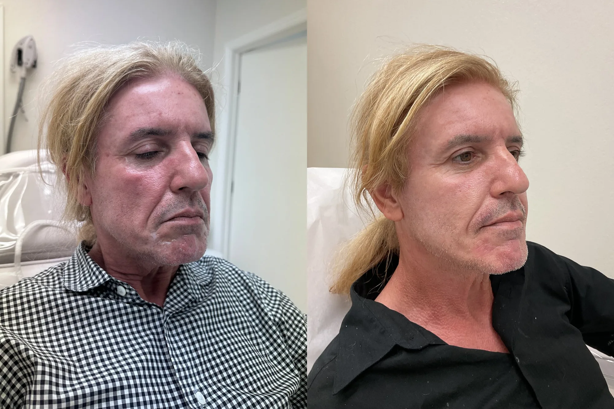Before and after a combined treatment plan, the same man at an angle, with less redness and smoother skin after