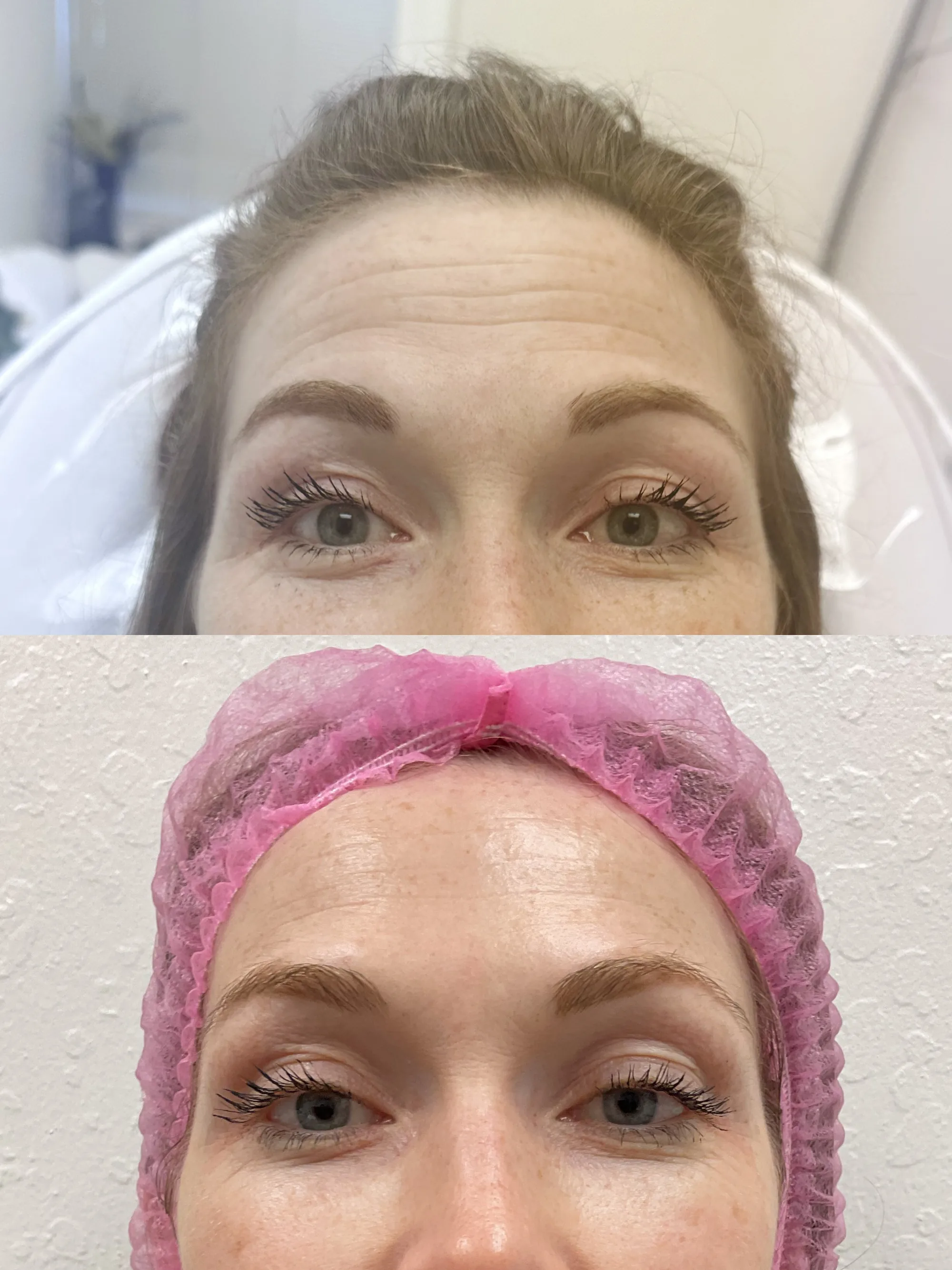 Before and after Jeuveau, front view of the forehead, with lines smoother after treatment