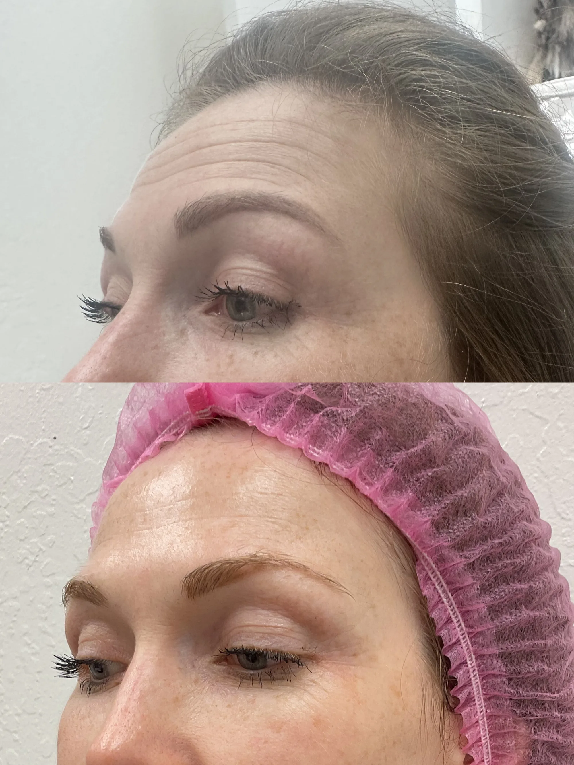 Before and after Jeuveau, the forehead at an angle, with fine lines softened after treatment