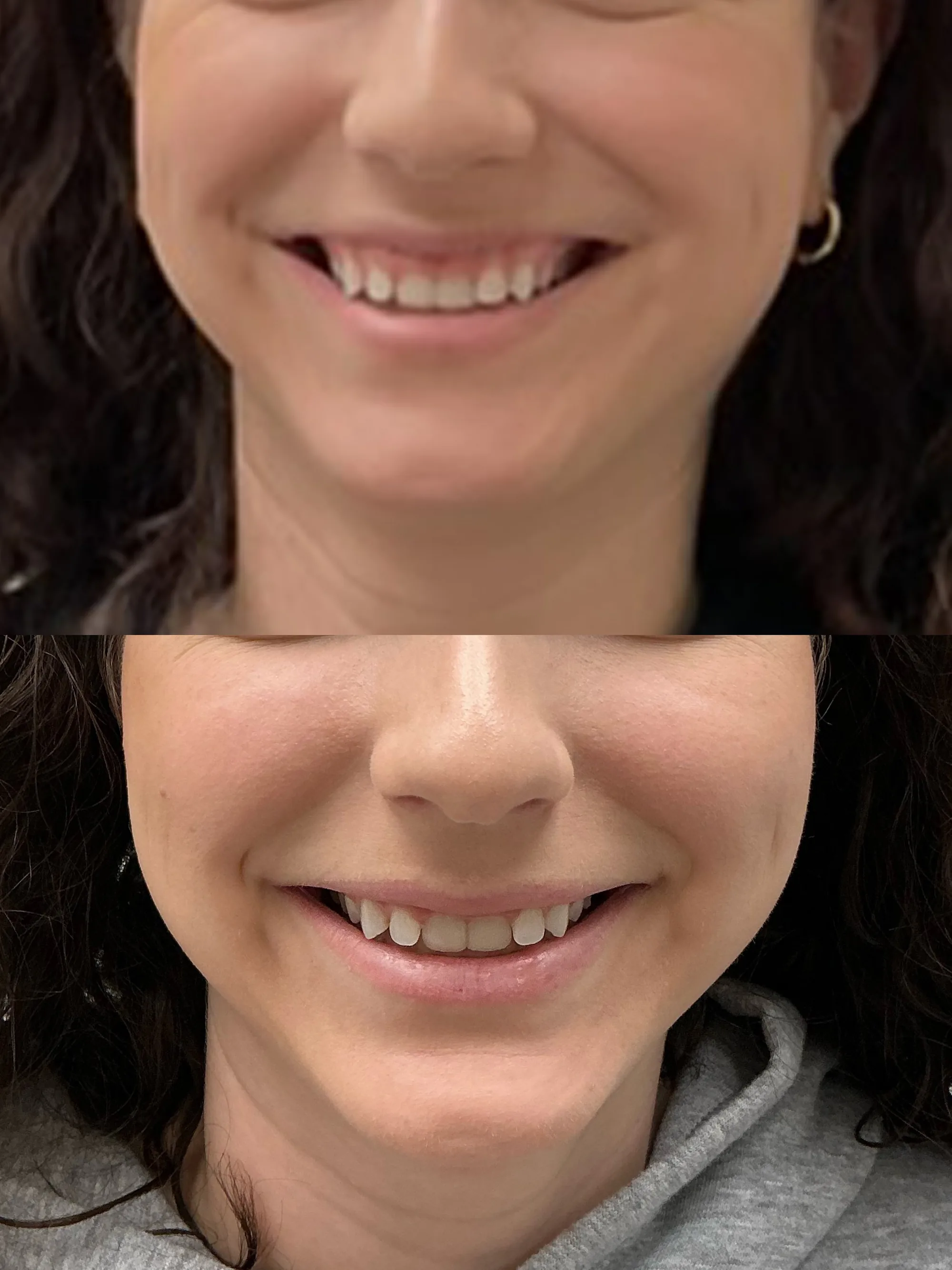 Before and after Jeuveau for a gummy smile, with less gum showing in the after photo