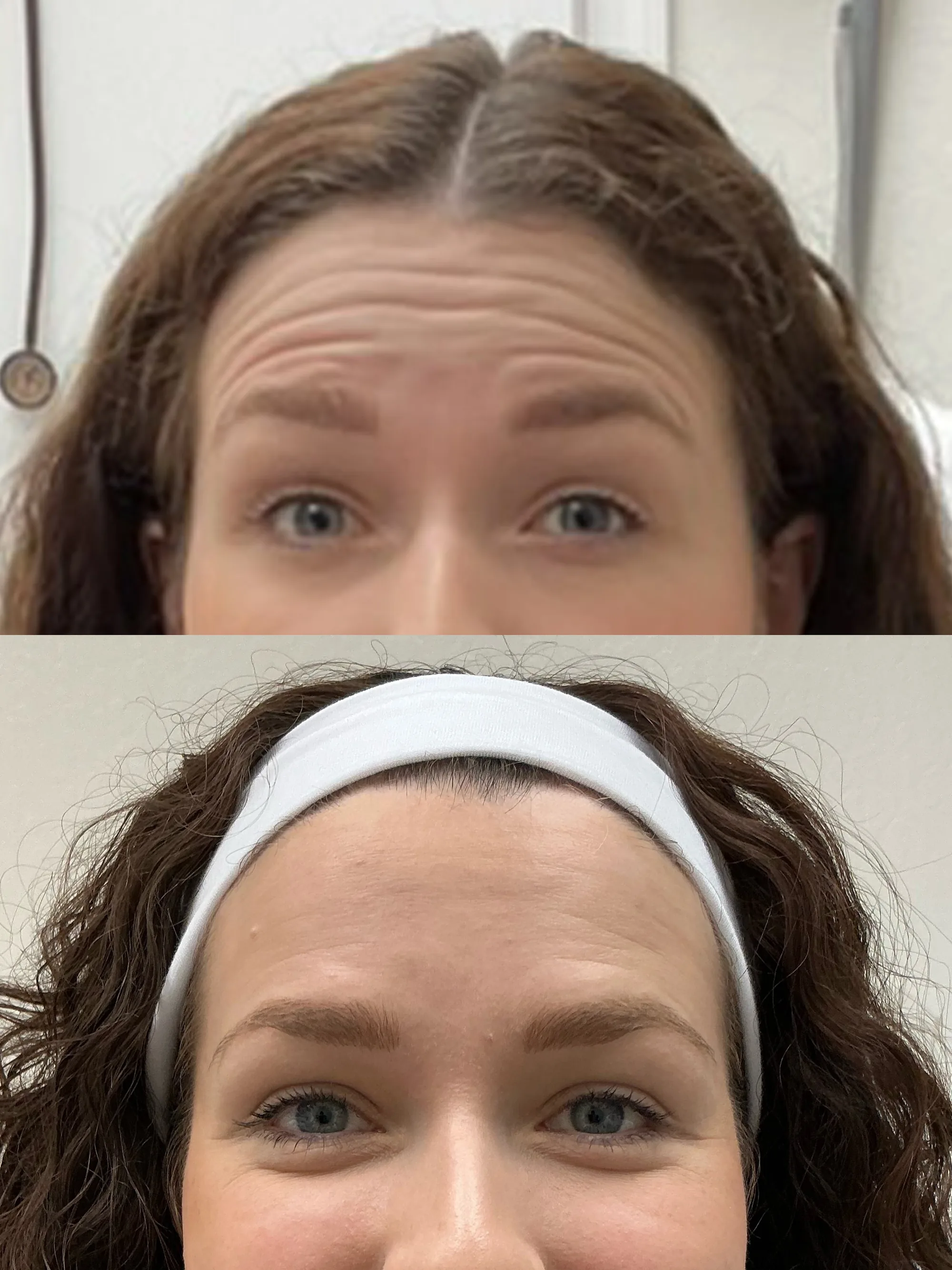 Before and after Jeuveau with raised brows, forehead lines deep before and smoother after