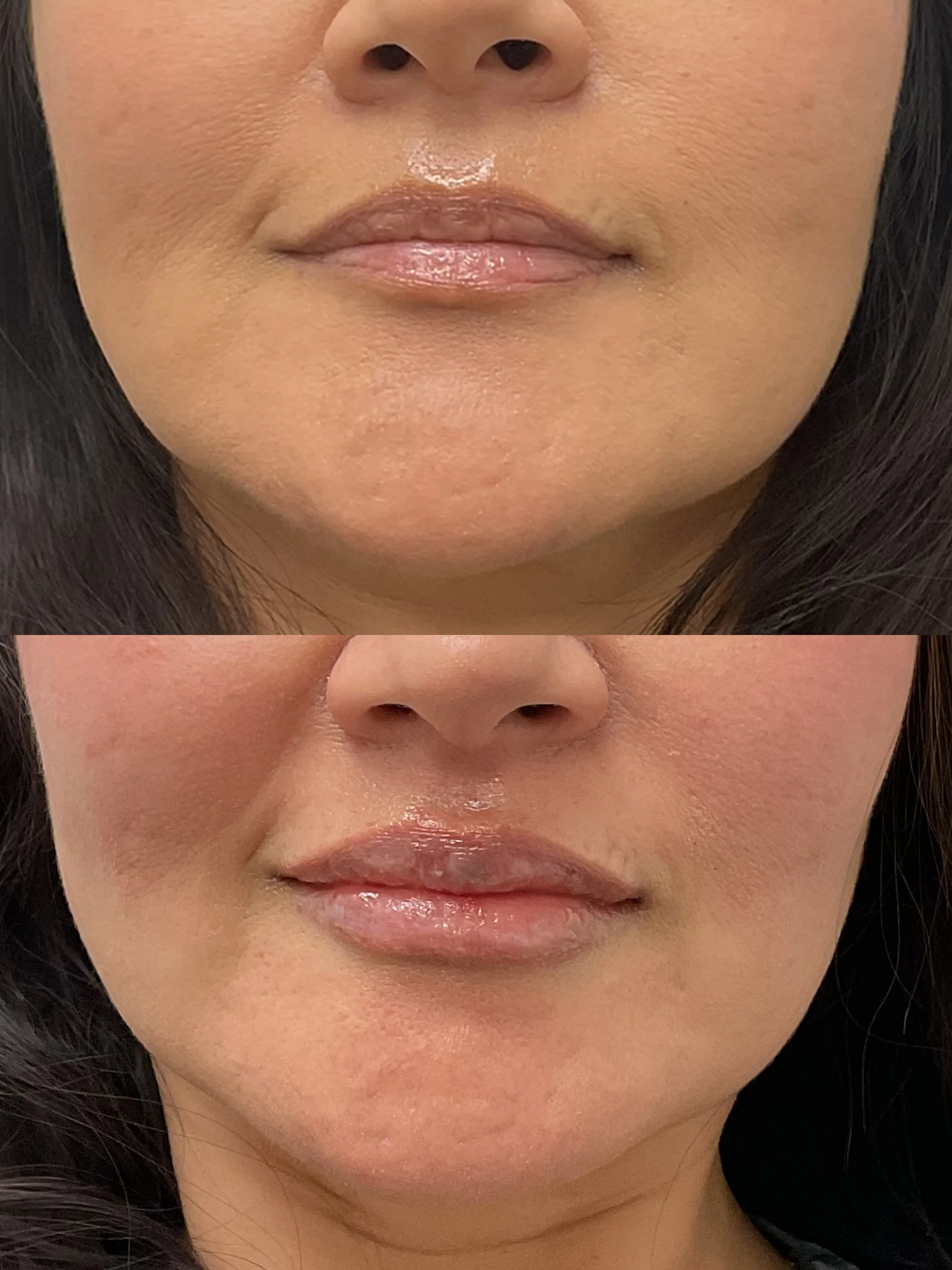 Before and after lip filler, front view, with fuller, more defined lips after treatment
