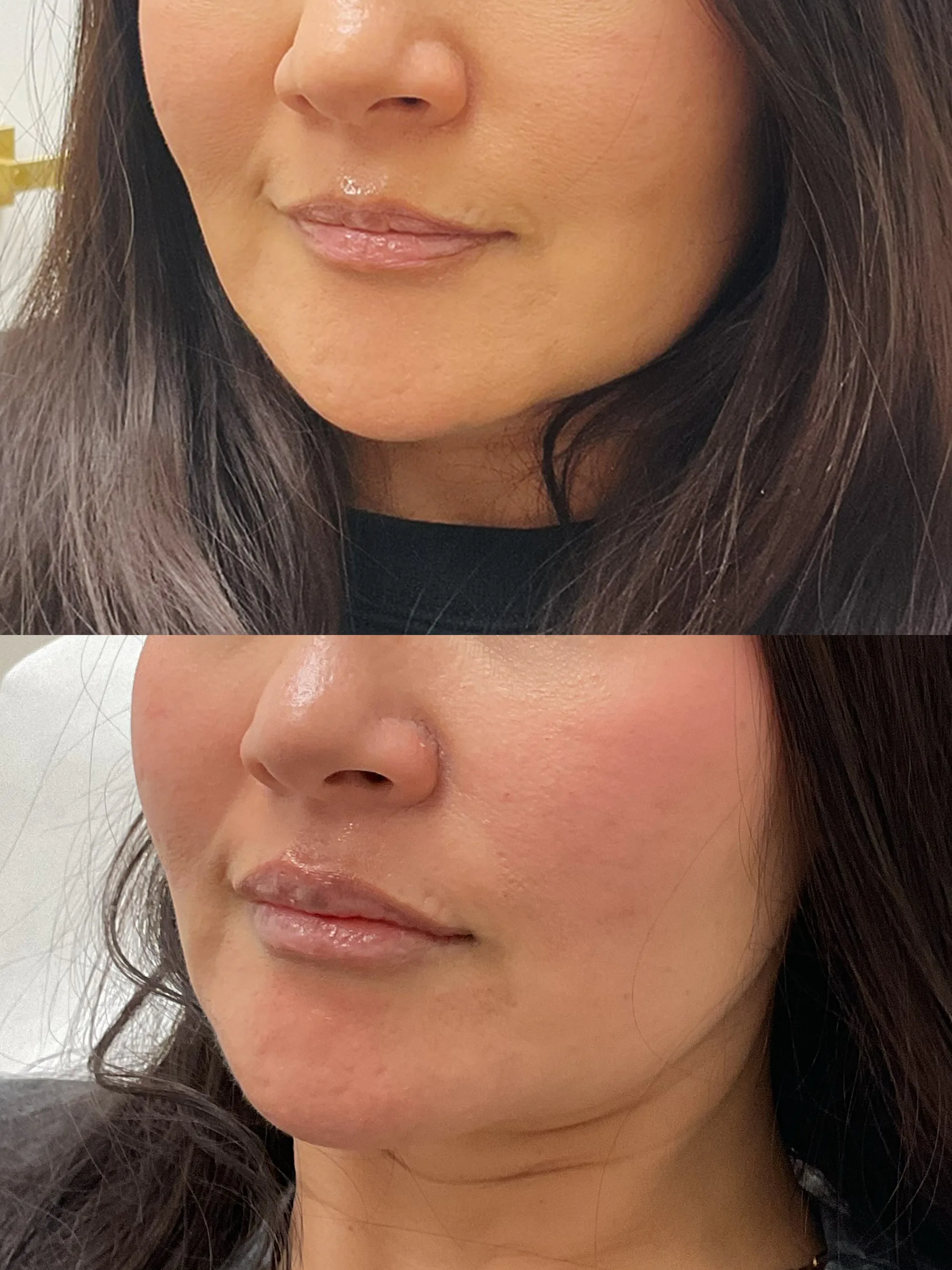Before and after lip filler seen at an angle, with soft added volume in both lips