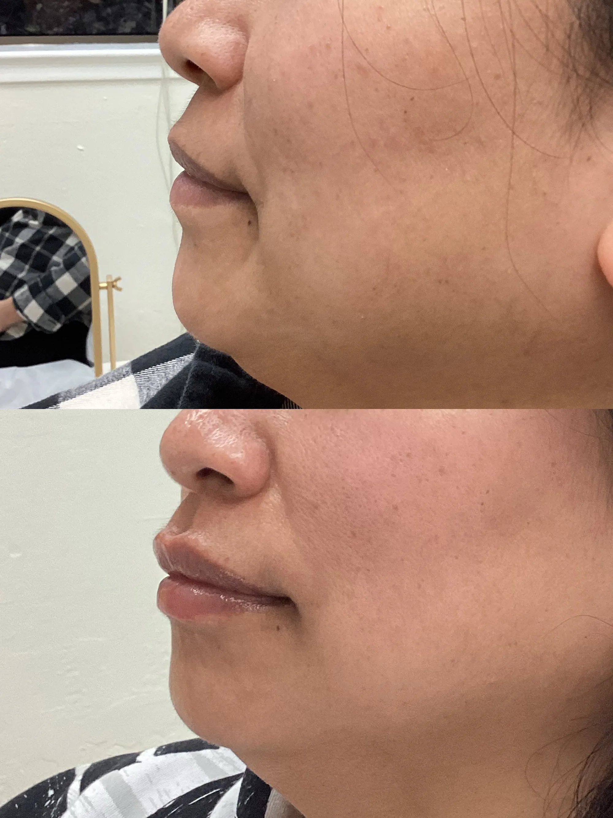 Before and after lip filler in profile, with more lip projection after treatment