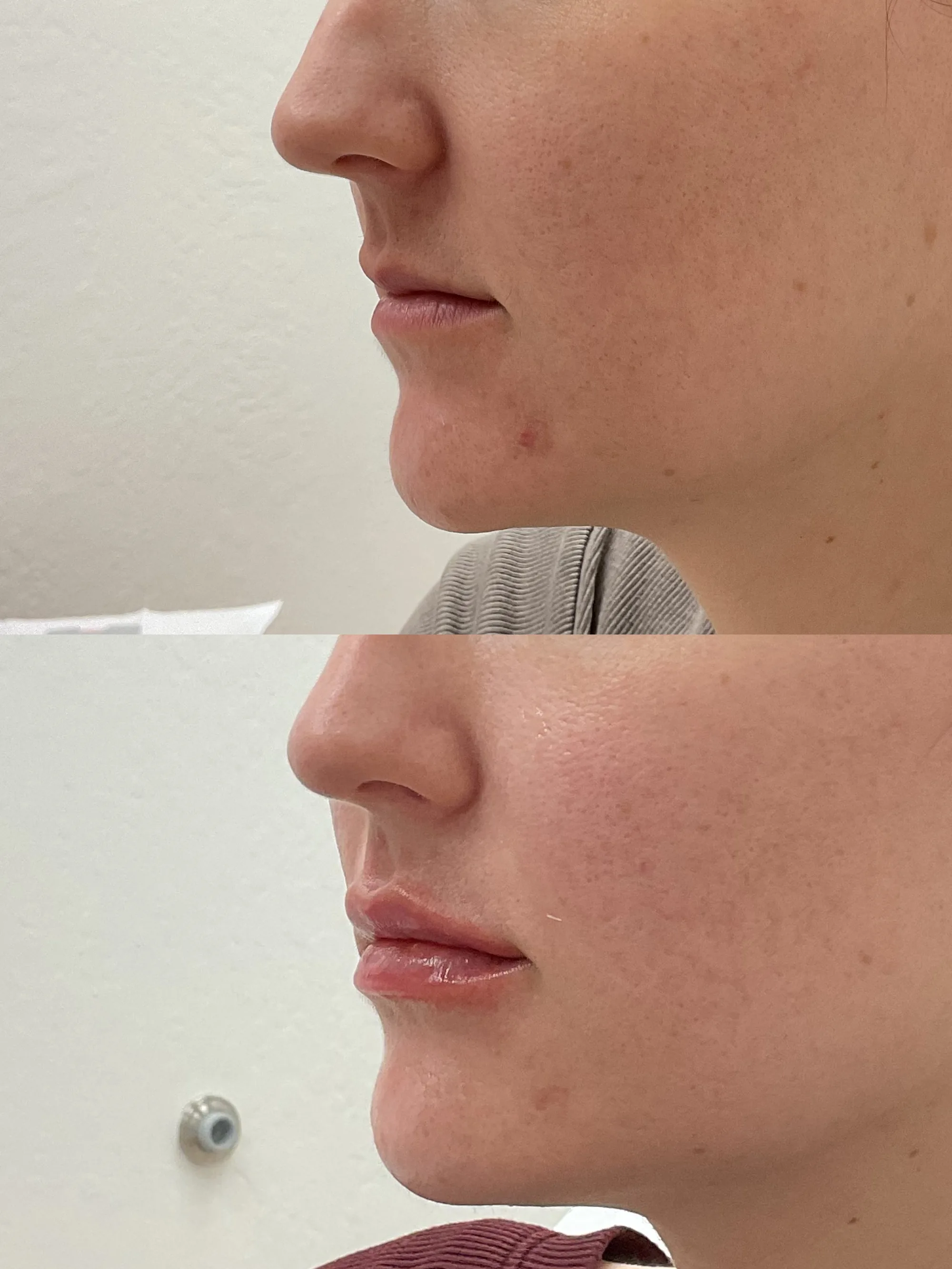 Before and after lip filler in profile, thin lips made fuller with a defined border