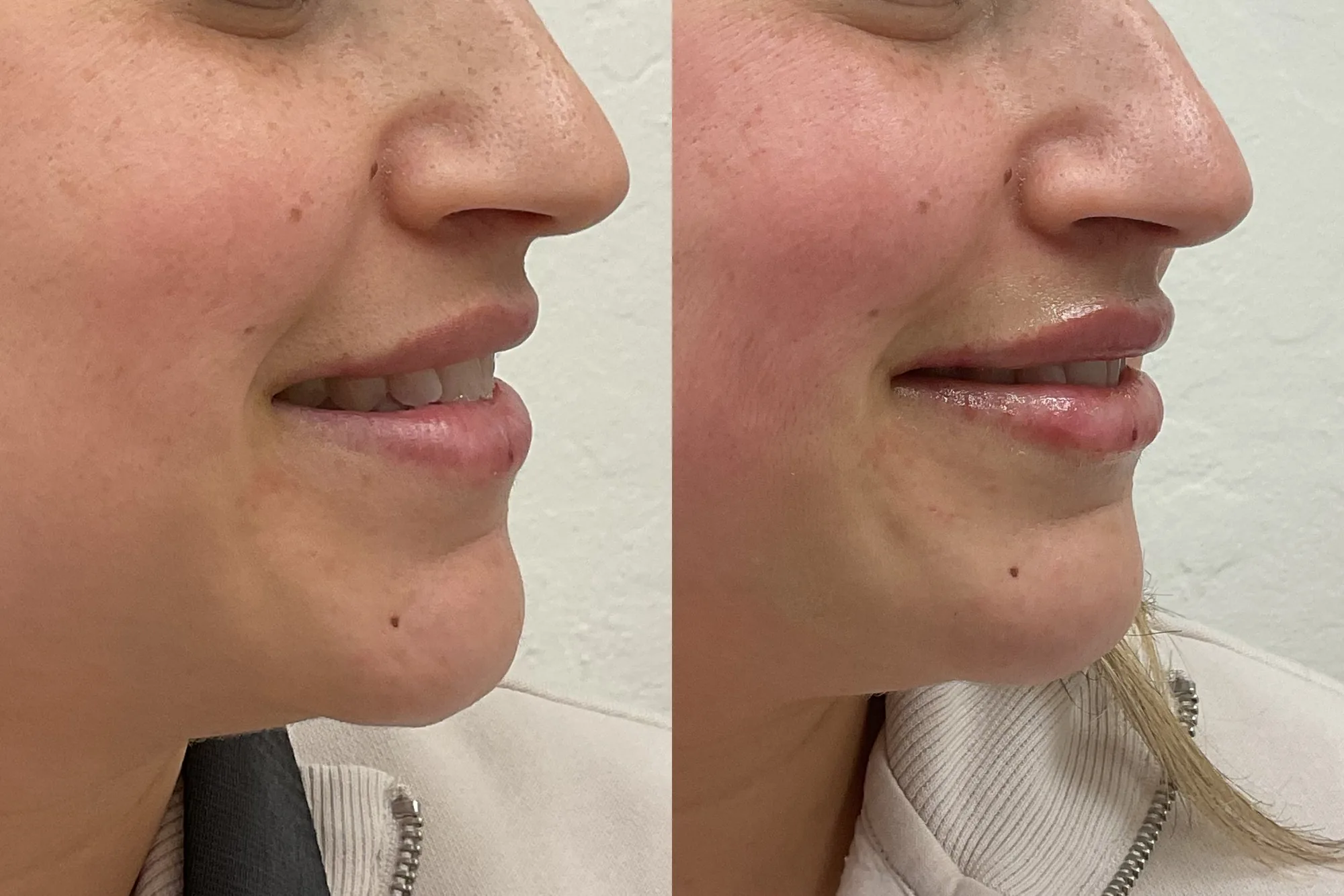 Before and after lip filler side by side at an angle, smiling, with a fuller upper lip