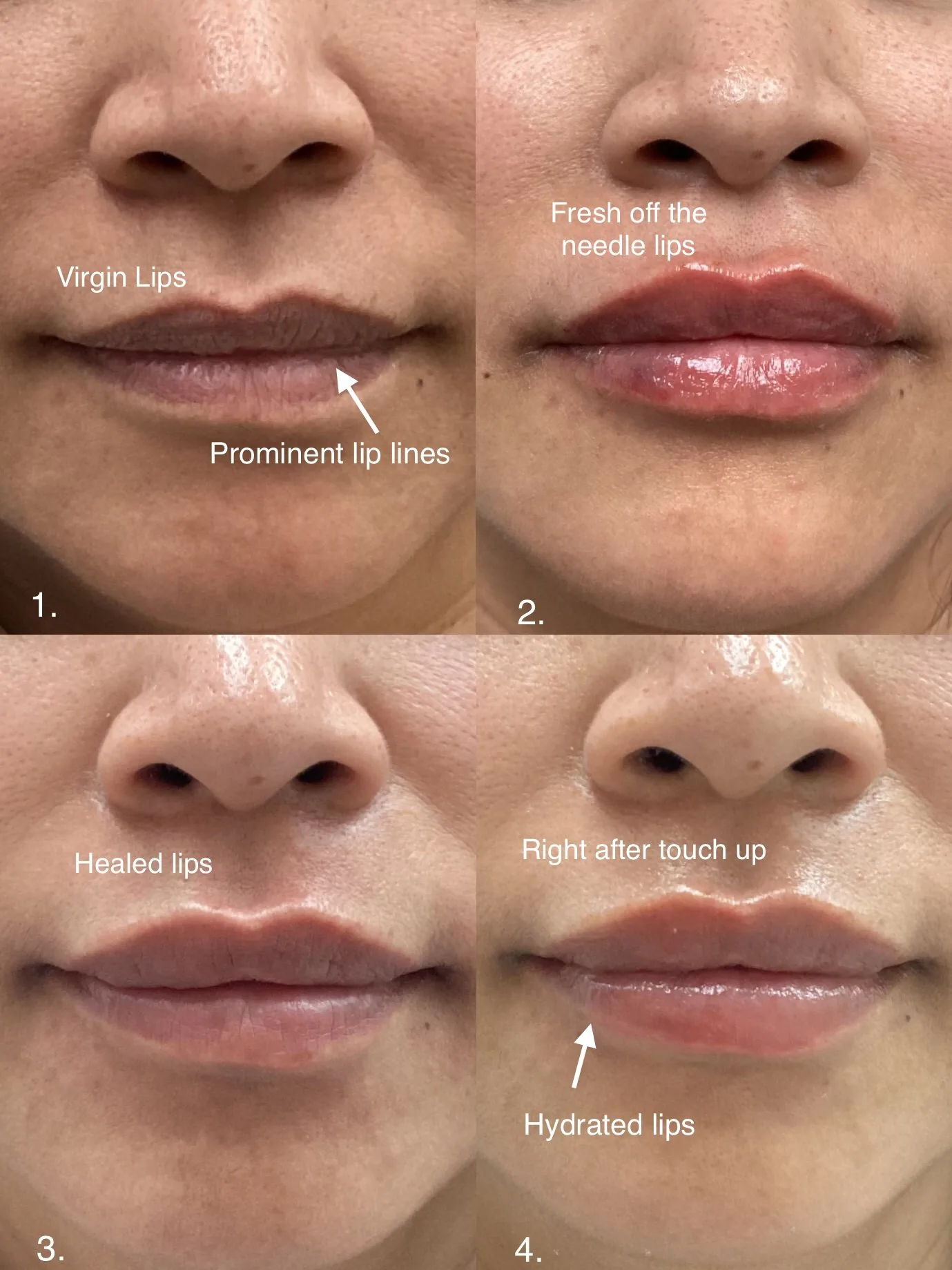 Four lip filler photos labeled natural lips with prominent lip lines, right after treatment, healed, and right after a touch-up