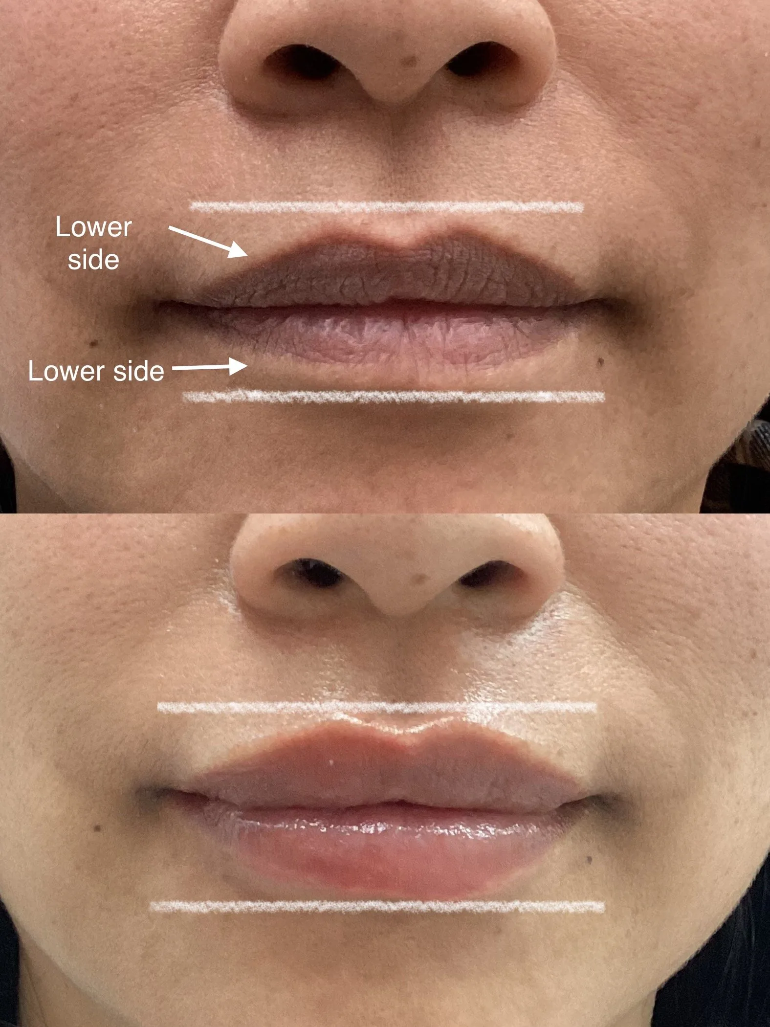 Before and after lip filler, front view, with guide lines showing uneven lower lip sides made more even