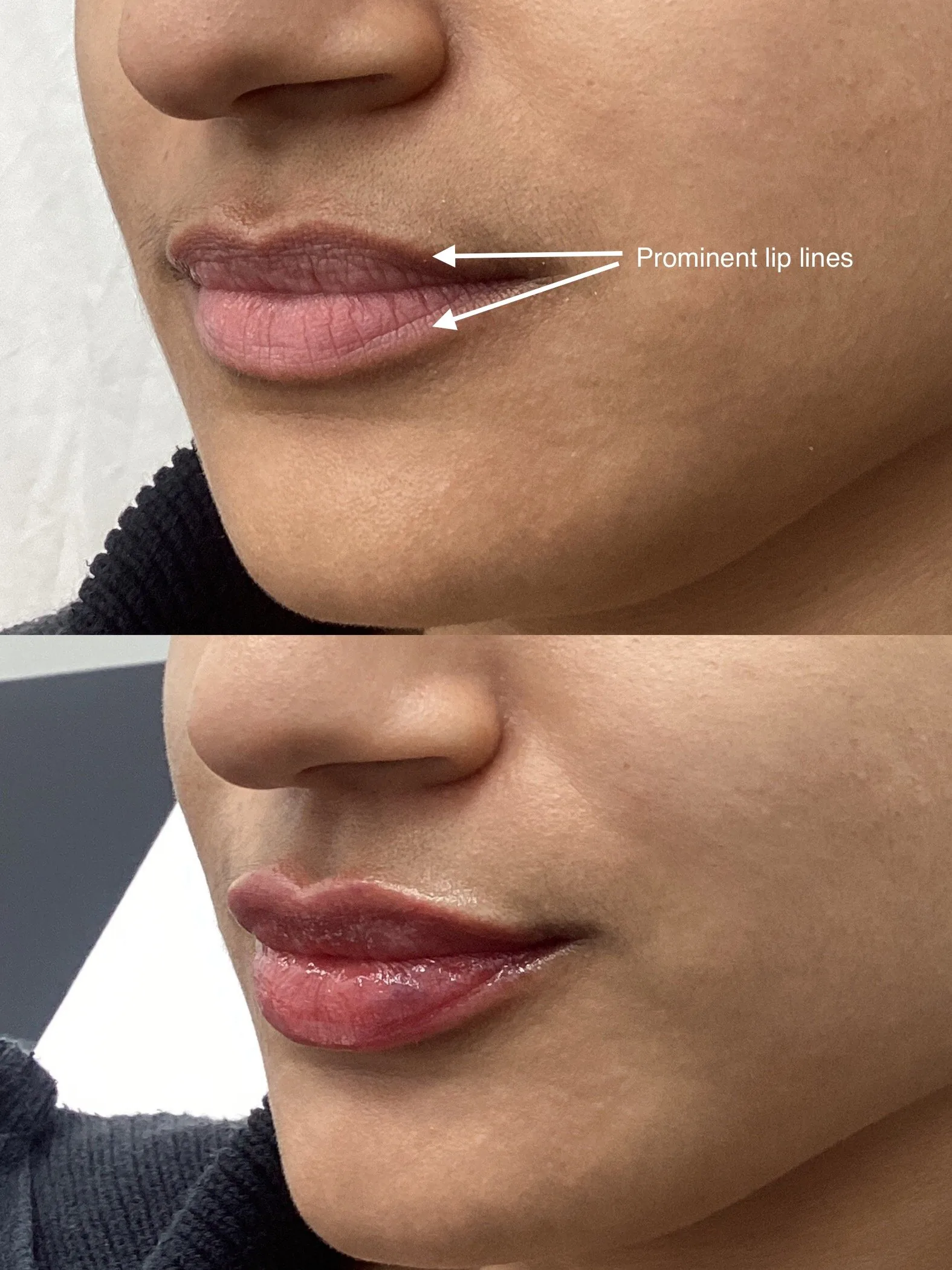 Before and after lip filler at an angle, with arrows marking prominent lip lines that look softer after
