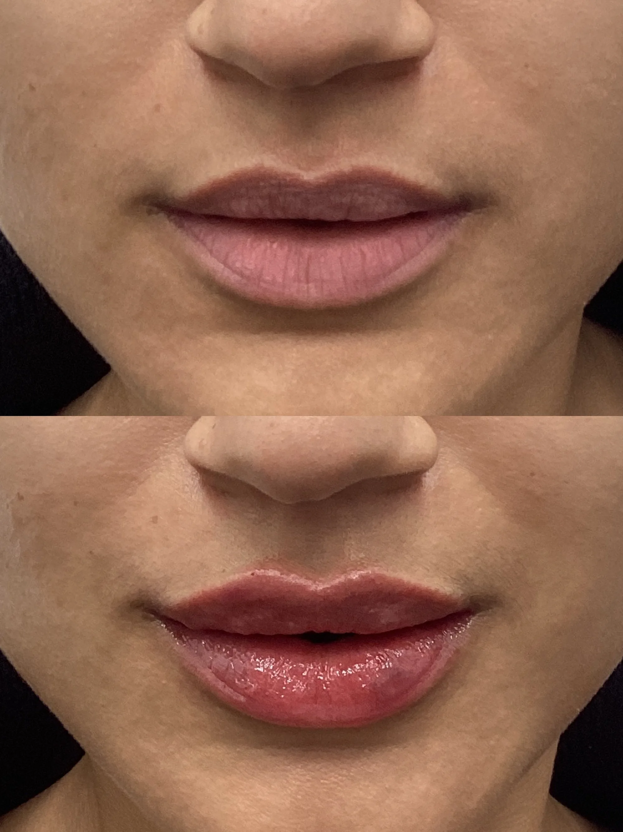 Before and after lip filler, front view, natural lips above and fuller lips below