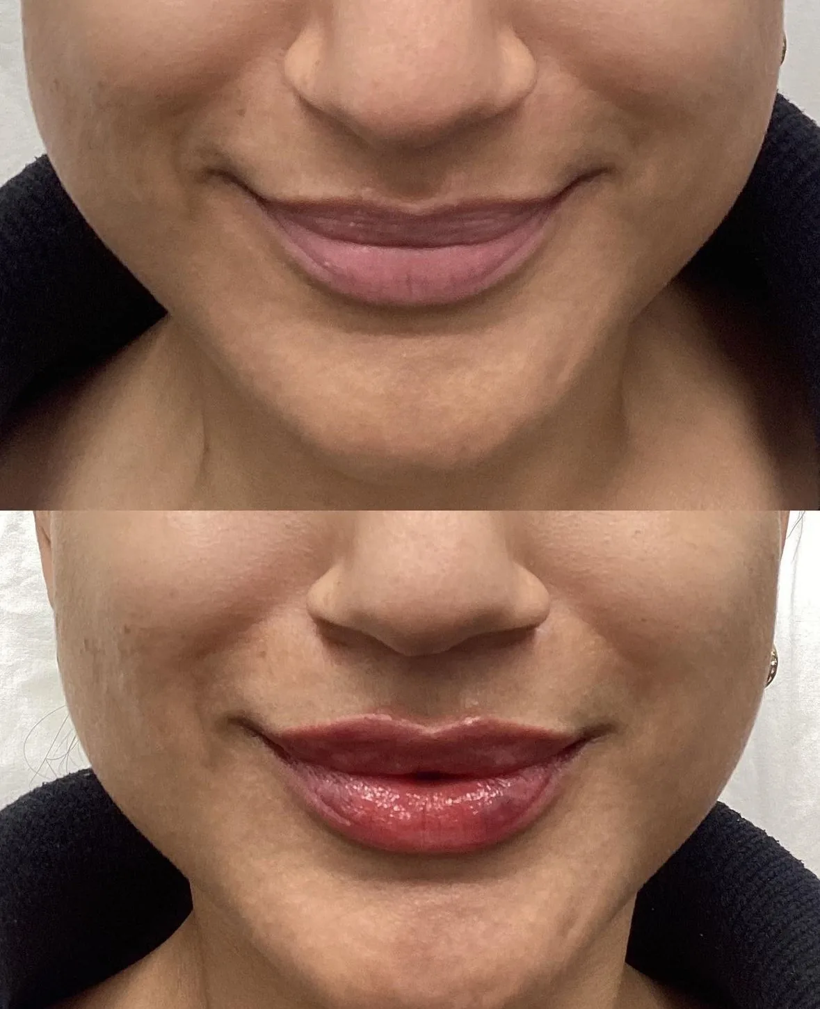 Before and after lip filler, front view with a slight smile, with fuller, more defined lips after