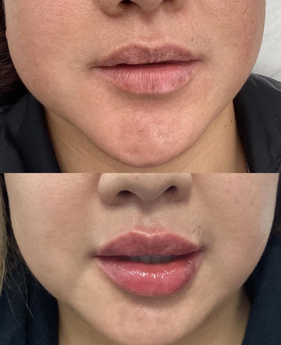 Before and after lip filler, front view, with added volume in the upper and lower lip