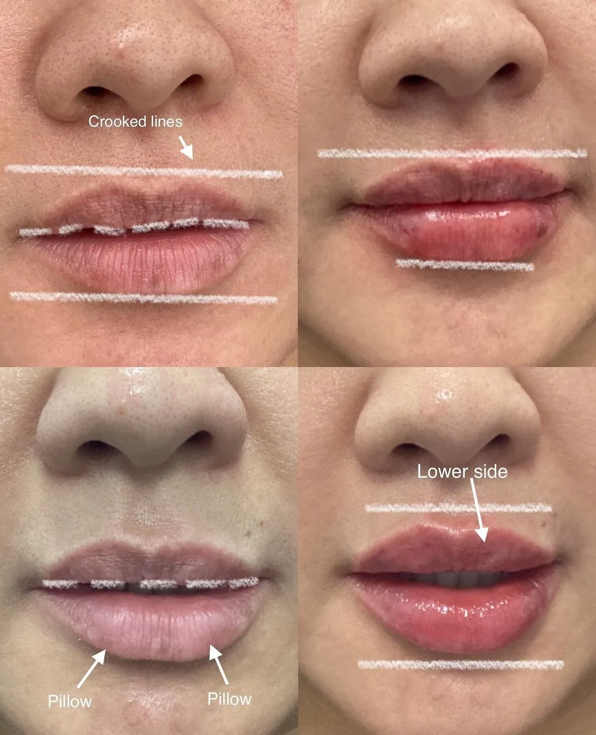 Four lip filler photos with guide lines marking crooked borders before and a more even lip shape after