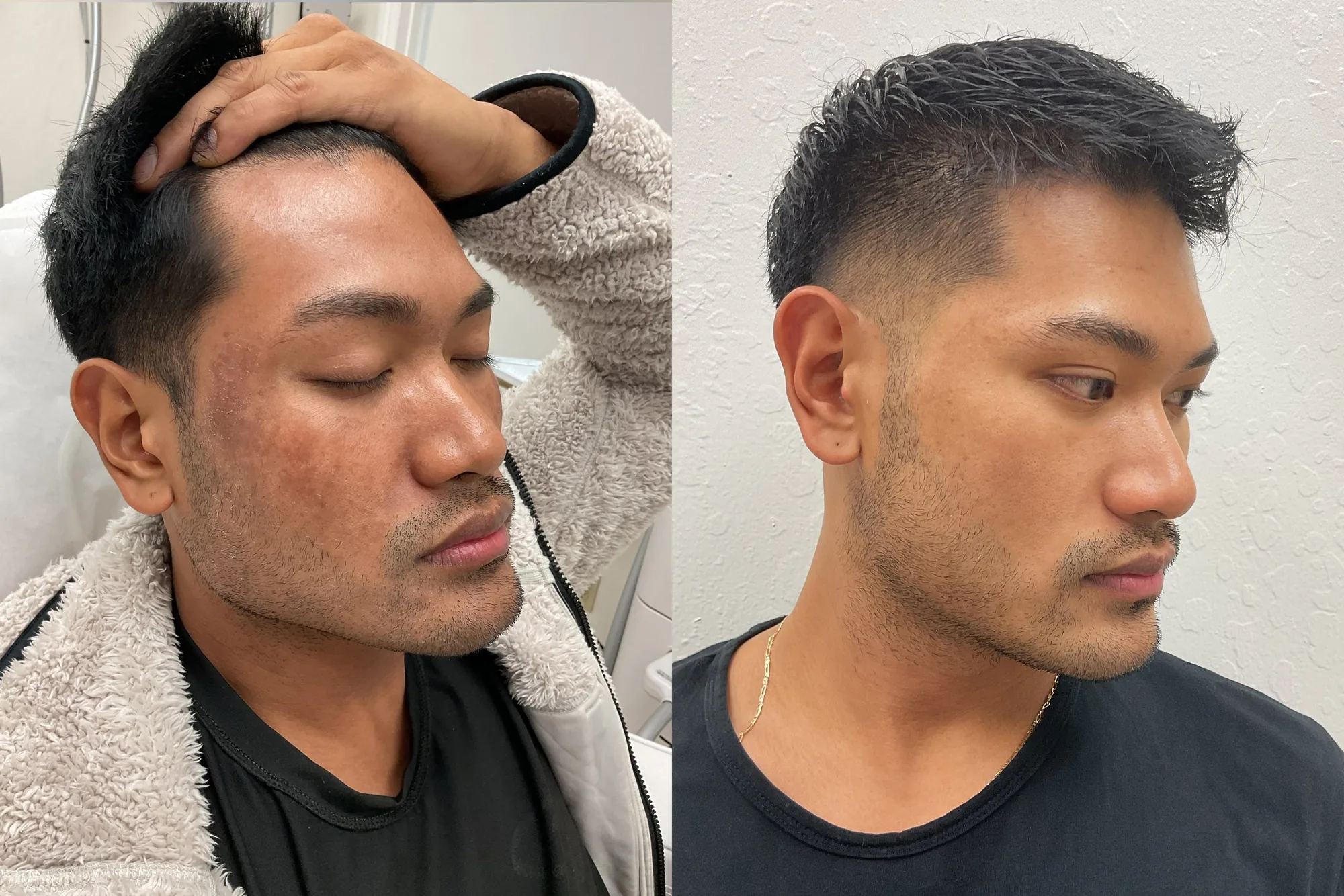 Before and after a chemical peel on a man's cheek, with calmer, more even skin after