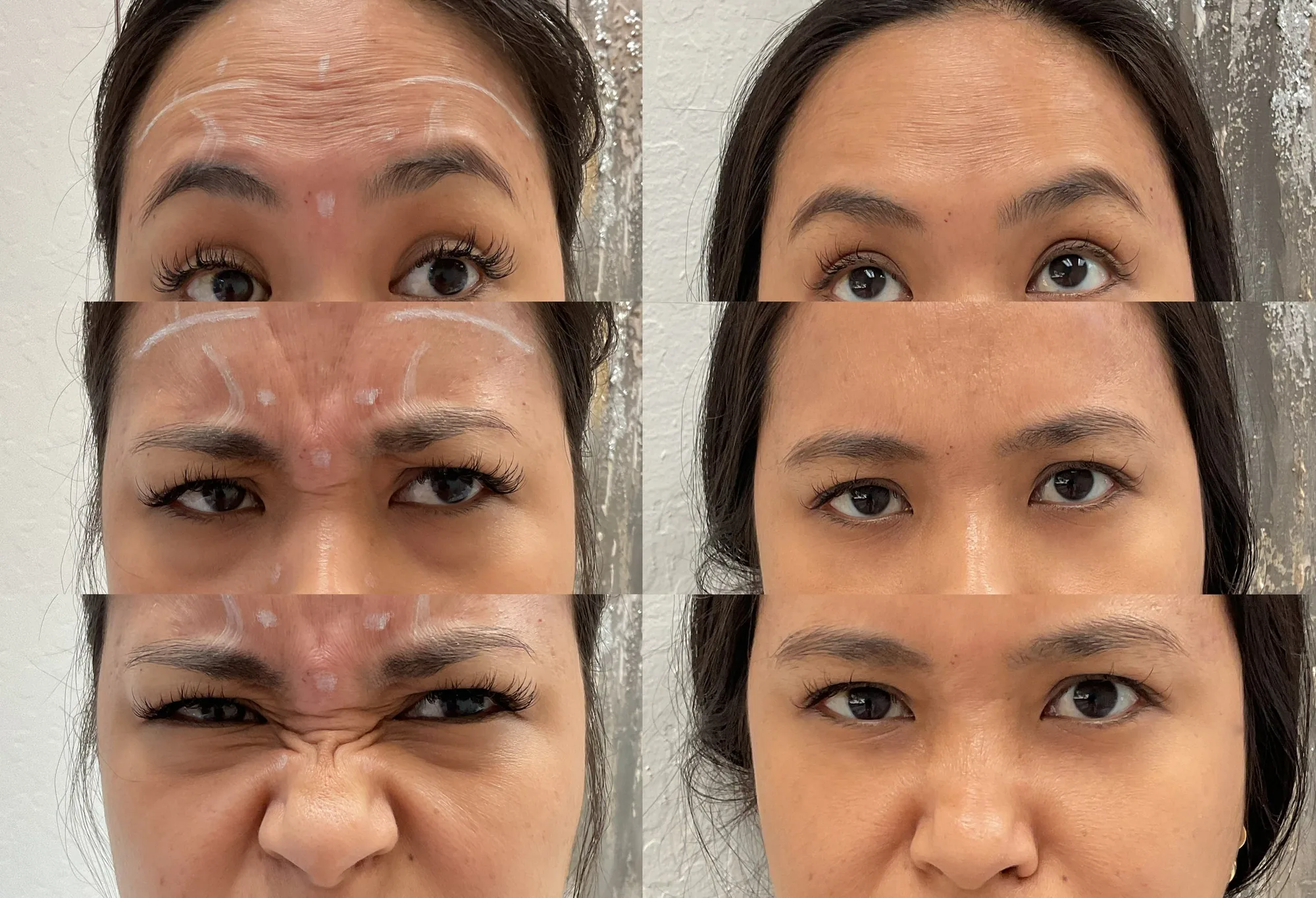 Before and after Xeomin in three expressions, raised brows, a frown and a scrunch, with lines softer after